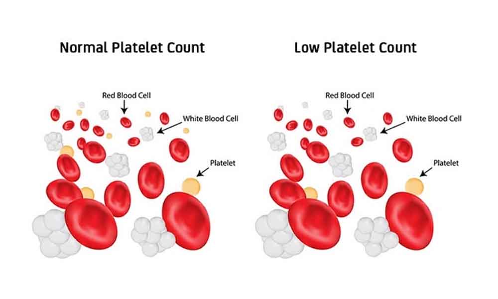 Platelet Count Range Chart Uk