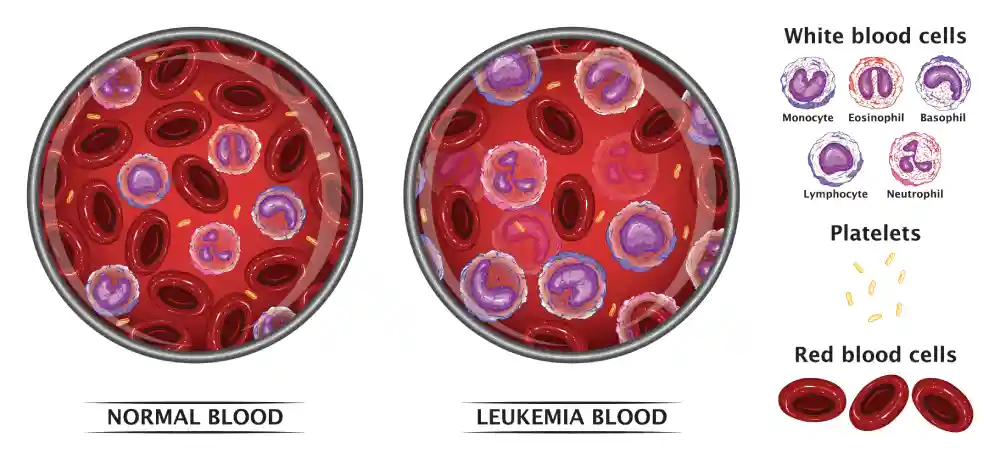 Top 15 Common Questions About Leukemia - Anti Leukemia